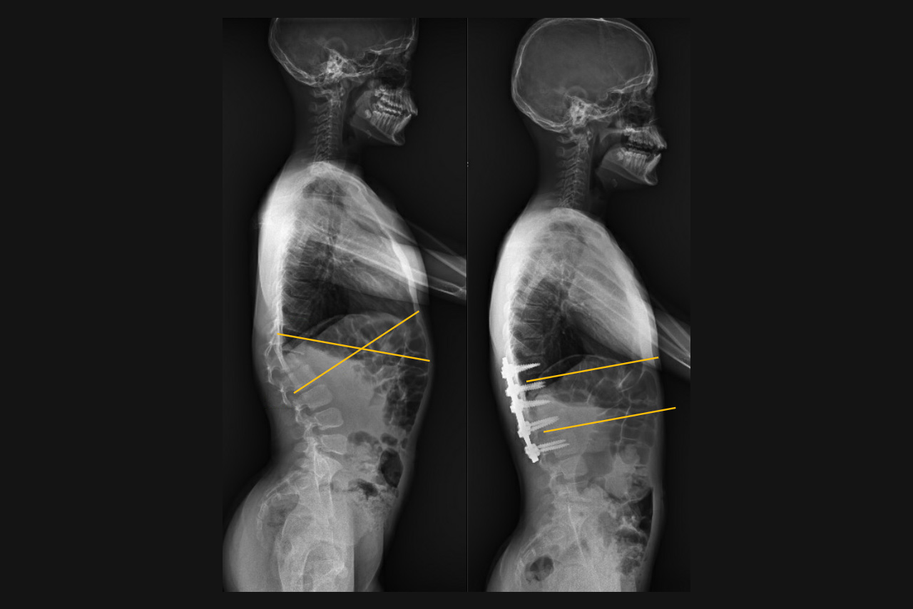 New Research Sheds Light On Defining Normal Sagittal Spinal Alignment